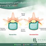 หมอนรองกระดูกทับเส้นประสาท (Herniated Nucleus Pulposus)
เป็นอาการที่เกิดขึ้น เป…