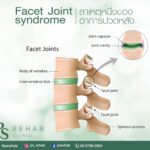 Facet joint syndrome คืออะไร
มากล่าวถึง Facet joint กันก่อน Facet เป็นหนึ่งในอง…
