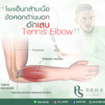 โรคTennis elbow หรือเรียกอีกอย่างว่า lateral epicondylitis เป็นอาการเจ็บ บริเวณข…