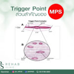 Trigger Point ส่วนสำคัญของ MPS
เราได้นำเสนอเกี่ยวกับอาการของ myofascial pain sy…