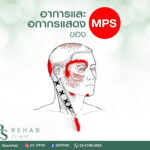 อาการของ MPS แบ่งได้เป็น 2 ระยะ
ตามความรุนแรง และ เวลาที่เป็น
1. ระยะเริ่มต้น …