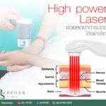 การรักษาด้วยแสงเลเซอร์พลังงานสูง
สามารถลดอาการปวด อาการอักเสบได้อย่างไรวันนี้ลอ…