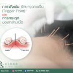 การฝังเข็ม (Dry-needling)
เป็นหนึ่งในวิธีการรักษา
Myofascial Pain syndrome
…