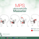 อ้าปากลำบาก ปวดร้าวไปยังฟัน!!
ท่านอาจมีอาการของ MPS ที่กล้ามเนื้อ Masseter
กล…
