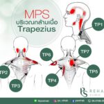 กล้ามเนื้อ Trapezius เป็นกล้ามเนื้อขนาดใหญ่ อยู่บริเวณหลังและคอ โดยยึดเกาะจากแนว…
