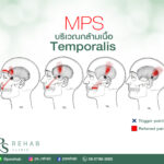 กล้ามเนื้อเทมโพราลิส (Temporalis muscle) เป็นกล้ามเนื้อรูปพัดอยู่ด้านข้างของขมับ…