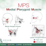 กล้ามเนื้อ Pterygoid ประกอบด้วย 2 ส่วน ได้แก่
– Medial pterygoid ทำหน้าที่ ยก…