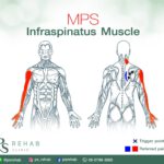 กล้ามเนื้อ Infraspinatus
เป็นกล้ามเนื้อที่อยู่บนกระดูกสะบักส่วนล่าง และมีจุดเกา…