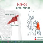 กล้ามเนื้อ Teres Minor
เป็นกล้ามเนื้อมัดเล็กๆ ที่เกาะอยู่บริเวณด้านหลังของกระดู…