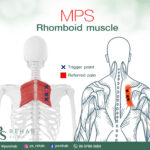 กล้ามเนื้อที่มีชื่อว่า ''Rhomboid muscle"
จะเเบ่งย่อยเป็น Rhomb…