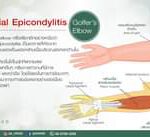 Medial epicondylitis หรือ Golfer’s elbow เป็นอาการที่เกิดจากการอักเสบของเอ็นของก…