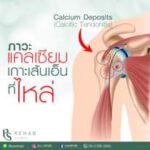 ภาวะแคลเซียมเกาะเส้นเอ็น (Calcific Tendonitis)
คือ การสะสมของแคลเซียมบริเวณเส้…