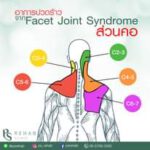 อาการปวดร้าวจาก FACET JOINT Syndrome บริเวณคอ
Facet Joint เป็นหนึ่งในองค์ประกอบ…