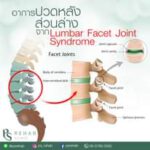 Lumbar Facet joint syndrome
เป็นความผิดปกติที่เกิดขึ้นบริเวณข้อต่อ Facet ของกระ…