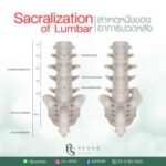 Sacralization เป็นอาการที่สามารถพบได้ไม่บ่อย
เป็นภาวะกระดูกกระเบนเหน็บติดกับกระ…