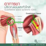 Quadrilateral space syndrome (QSS) เป็นโรคที่เกิดจากการใช้กล้ามเนื้อมากเกินไป ทำ…