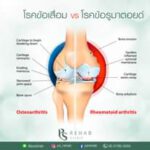โรคข้อเสื่อม VS โรคข้อรูมาตอยด์
โรคข้อเสื่อม
เกิดขึ้นจากผิวกระดูกอ่อน บริเวณข…