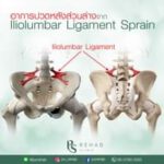Iliolumbar Ligament
เส้นเอ็นอิลิโอลัมบ้า เป็นเส้นเอ็นขนาดใหญ่ที่ช่วยสร้างความมั…