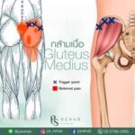 Gluteus Medius
เป็นกล้ามเนื้อที่อยู่ใต้กล้ามเนื้อ Gluteus maximus มีรูปร่างคล้า…