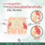 Bursitis คืออาการอักเสบของ Bursa หรือถุงน้ำกันกระแทกขนาดเล็ก ที่พบได้รอบๆ ข้อต่อ…